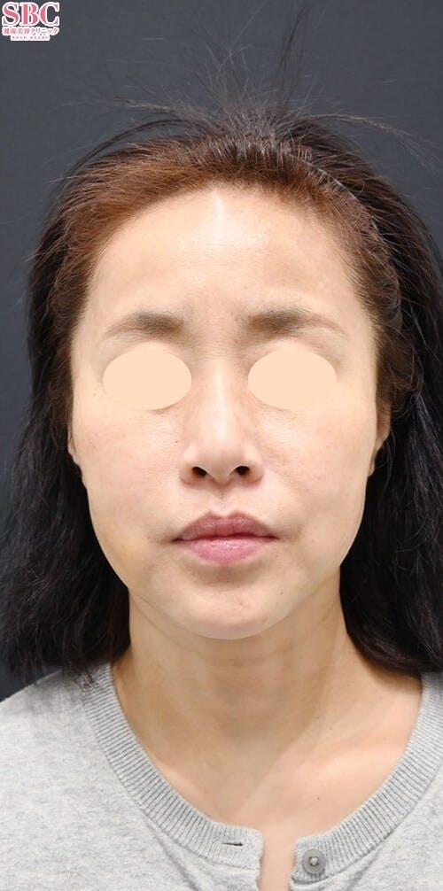 【50代女性・たるみ】ヒアルロン酸_after