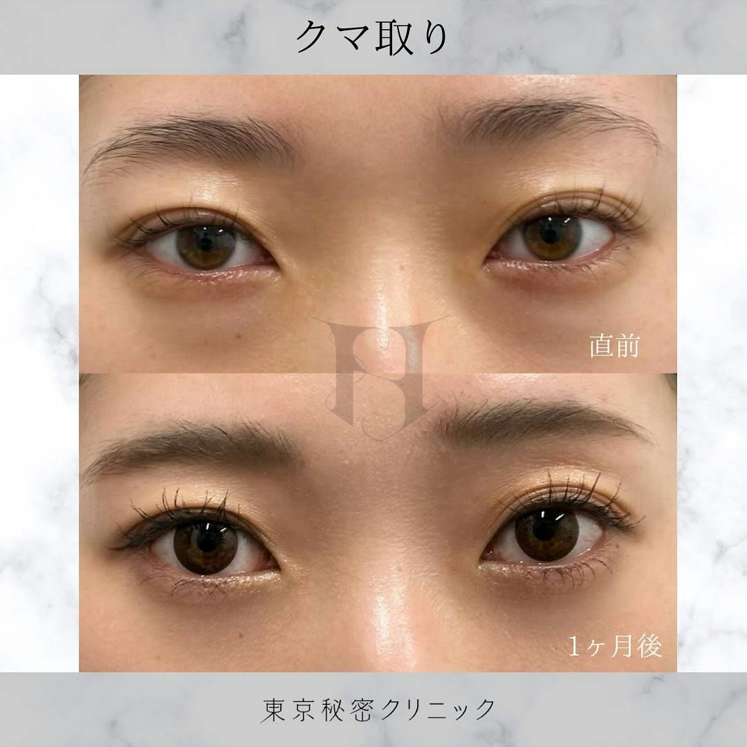 【女性・目元】クマ取り_before_aftar