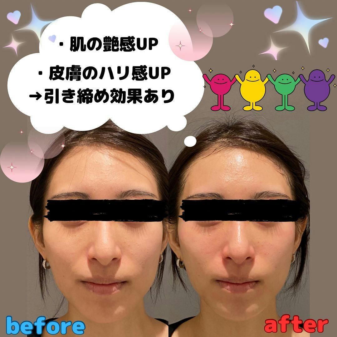 【女性・肌】マッサージピール_before_aftar