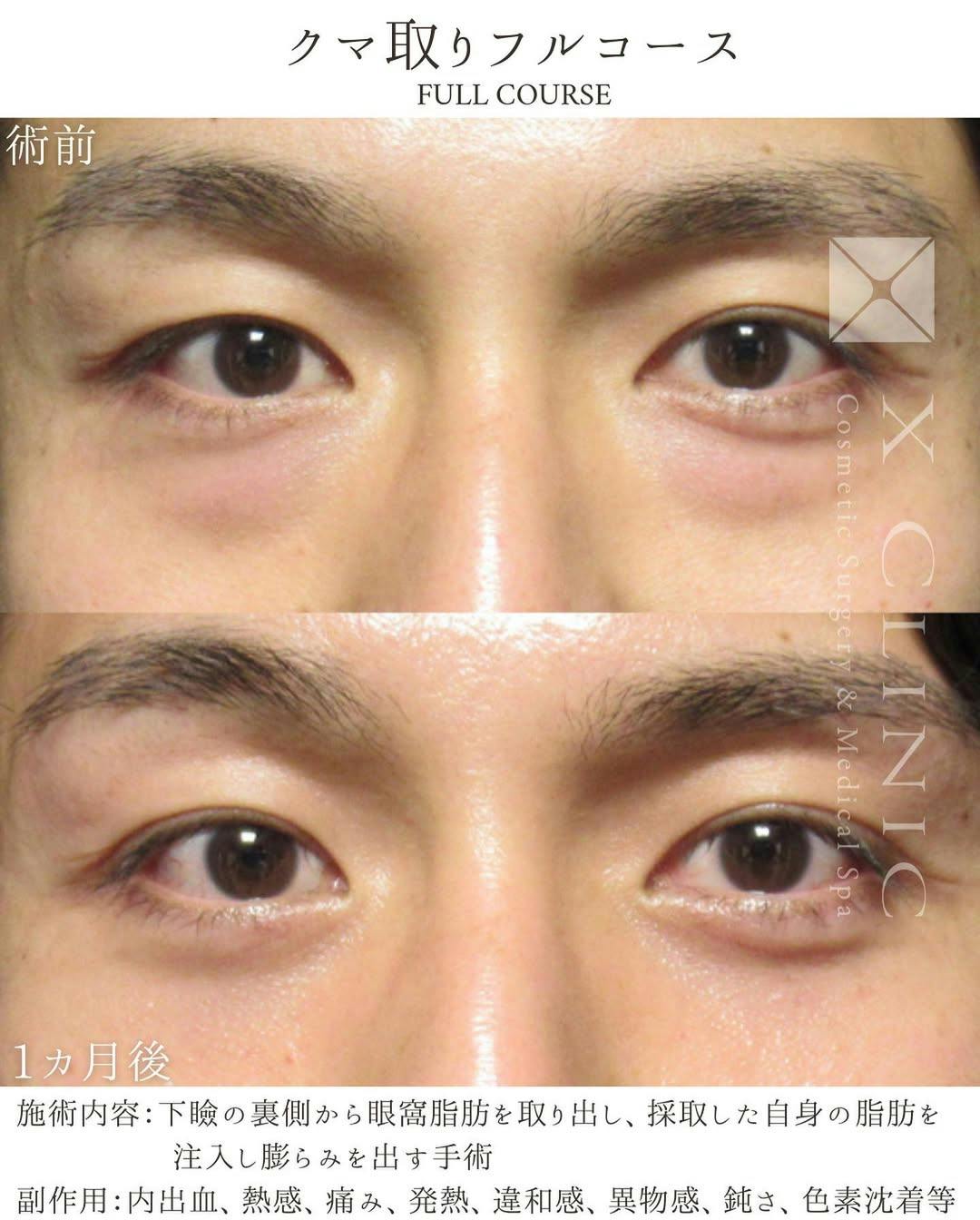 【男性・目元】クマ取りフルコース_before_aftar