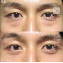 【男性・目元】クマ取りフルコース_before_aftar