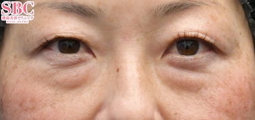 【女性・目元】目の下の切らないクマ・たるみ（ふくらみ）取り、ナチュラル脂肪注射コンデンスリッチ、ナチュラル脂肪注射ナノリッチ_before