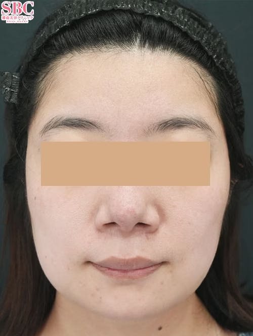 【女性・輪郭】小顔用脂肪吸引注射_before