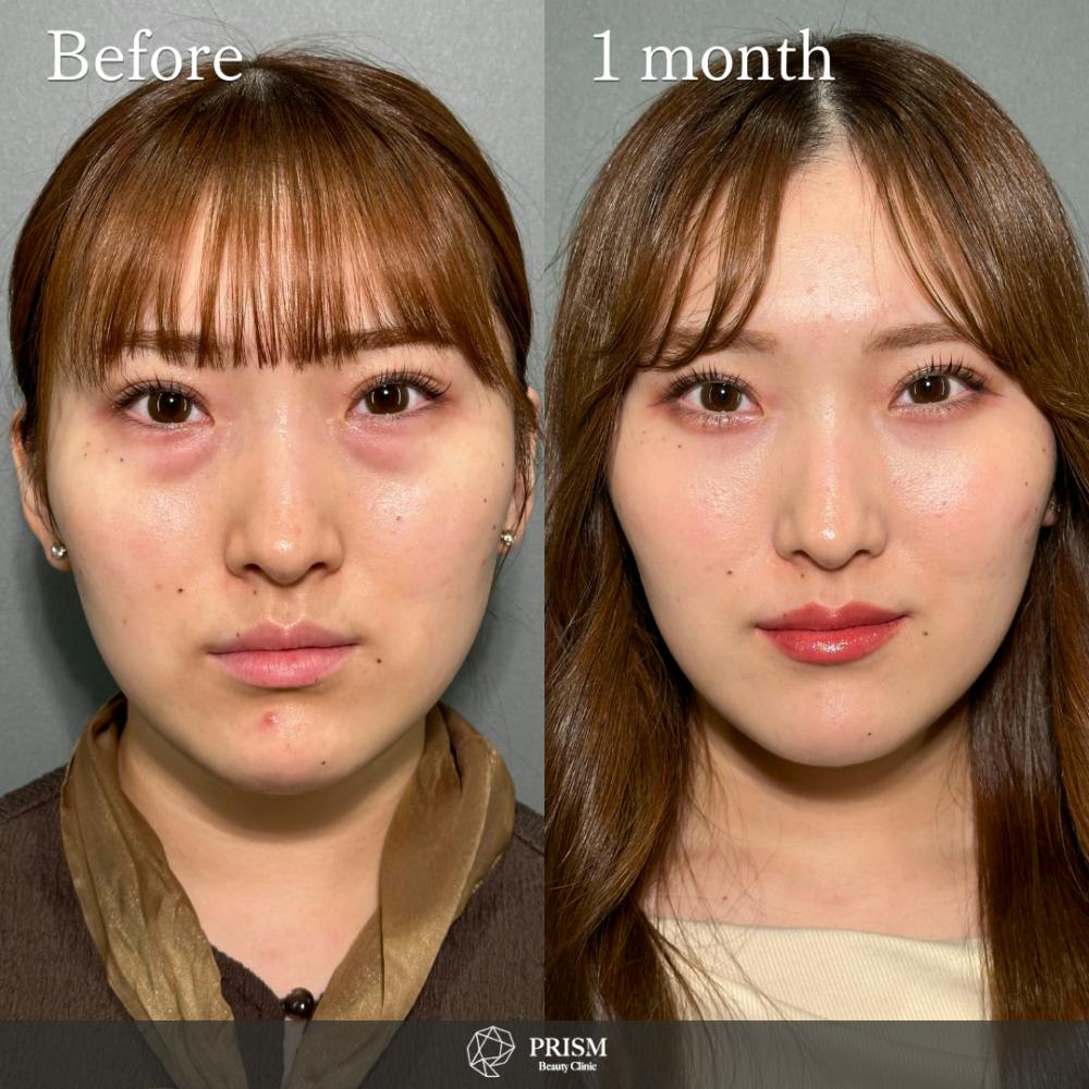 【20代女性・目】切らない目の下のクマ取り＋ヒアルロン酸（目の下）_before_aftar