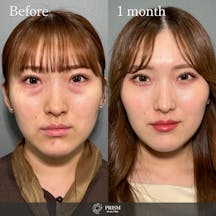 【20代女性・目】切らない目の下のクマ取り+ヒアルロン酸(目の下)_before_aftar