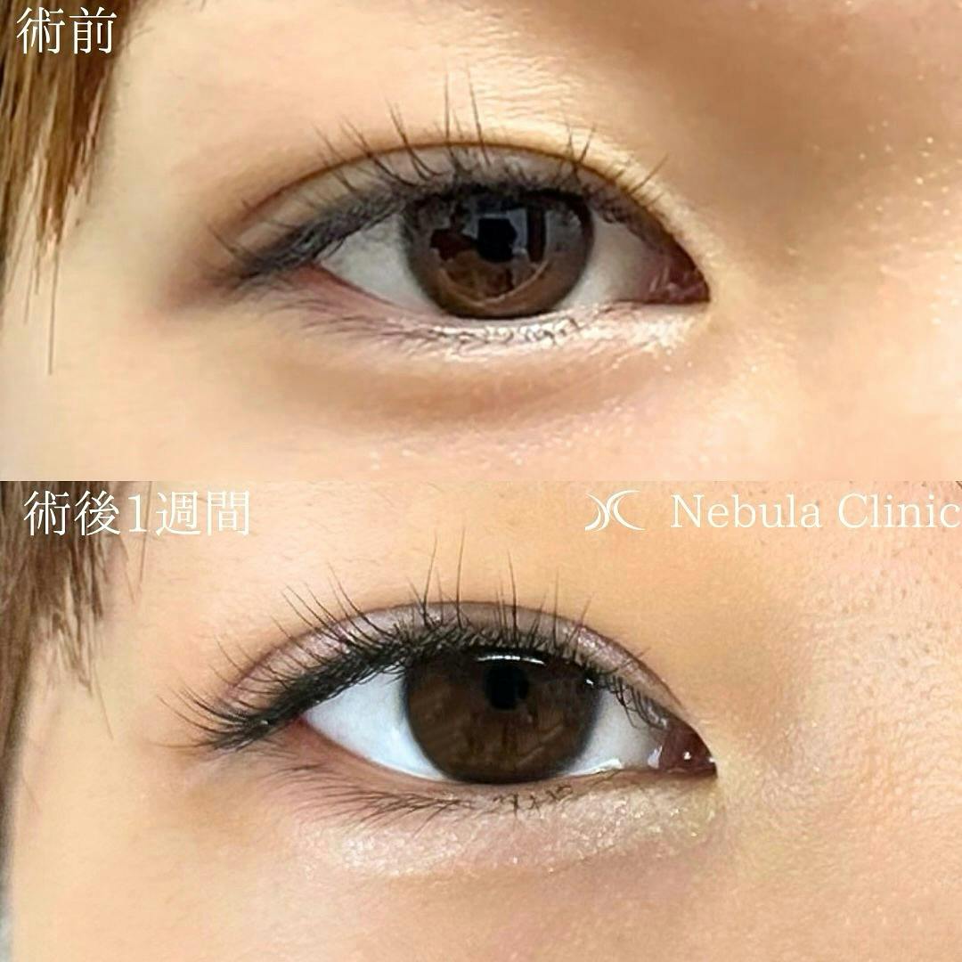 【女性・目元】二重埋没法_before_aftar