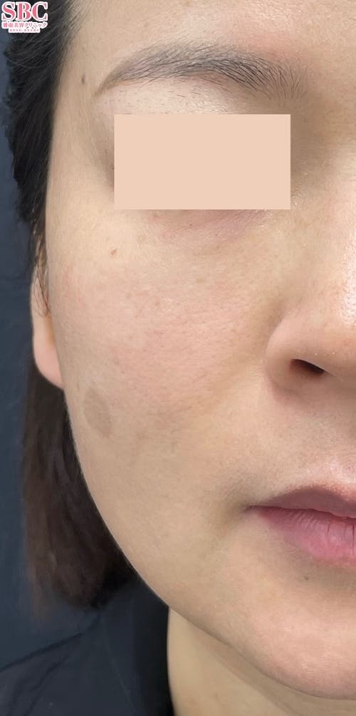 【女性・顔・ほうれい線】ヒアルロン酸ジュビダームビスタ バイクロスシリーズ・VOV(ボブ)リフト・シークレットリフト_after