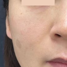 【女性・顔・ほうれい線】ヒアルロン酸ジュビダームビスタ バイクロスシリーズ・VOV(ボブ)リフト・シークレットリフト_after