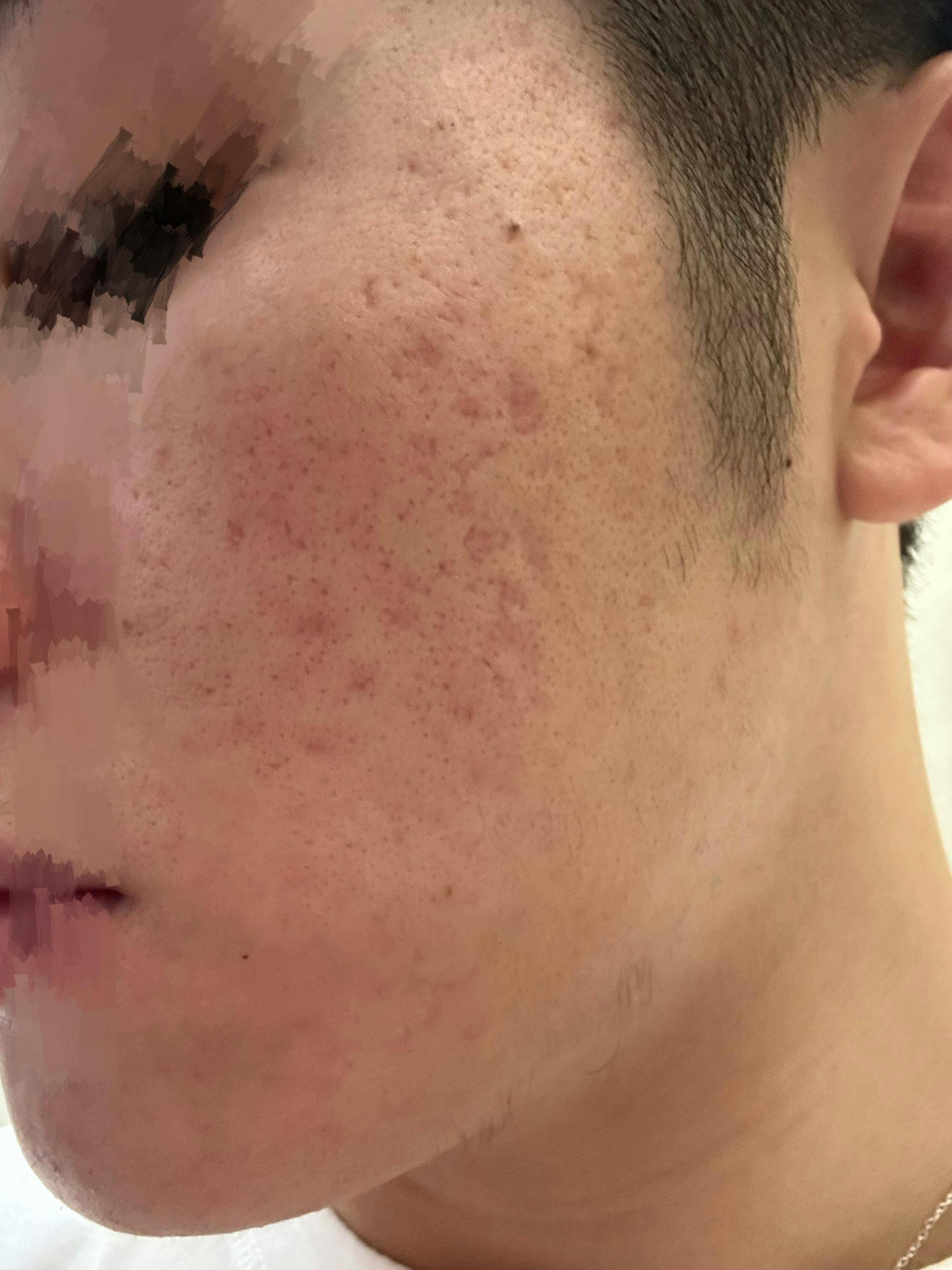 湘南美容クリニック 水戸院でダーマペン：ダーマペンを受けたみみさんの写真
