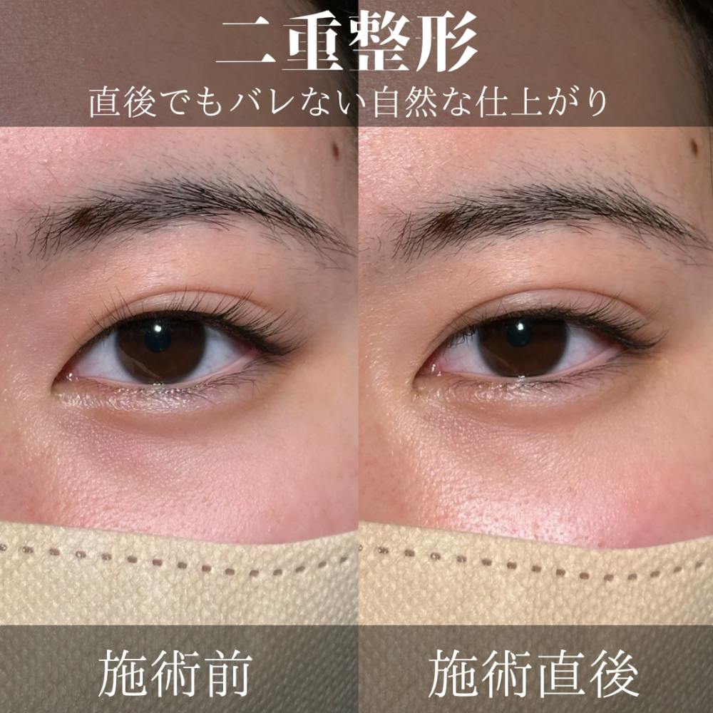 【女性・目】二重埋没_before_aftar