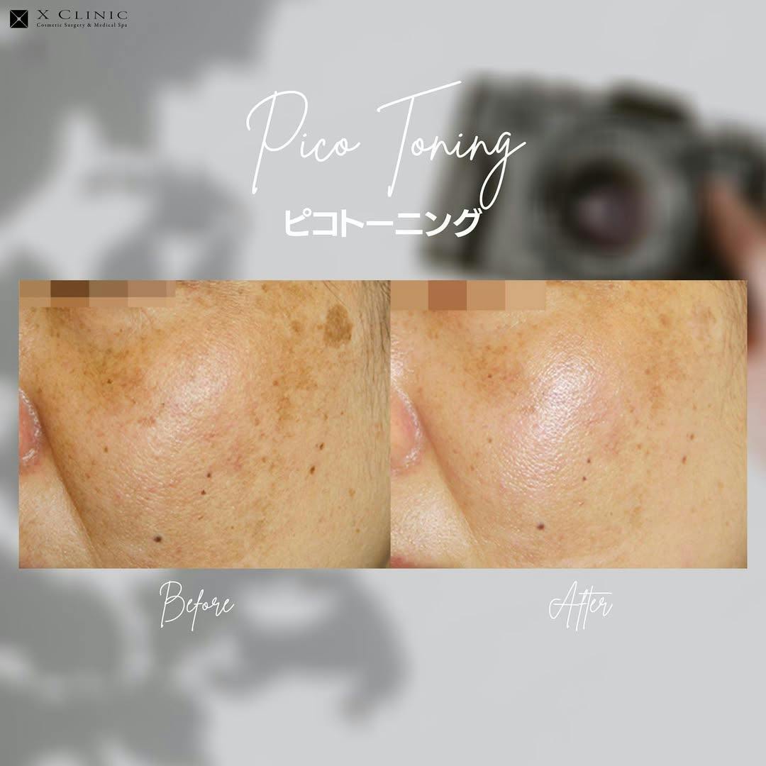 【肝斑】ピコトーニング_before_aftar