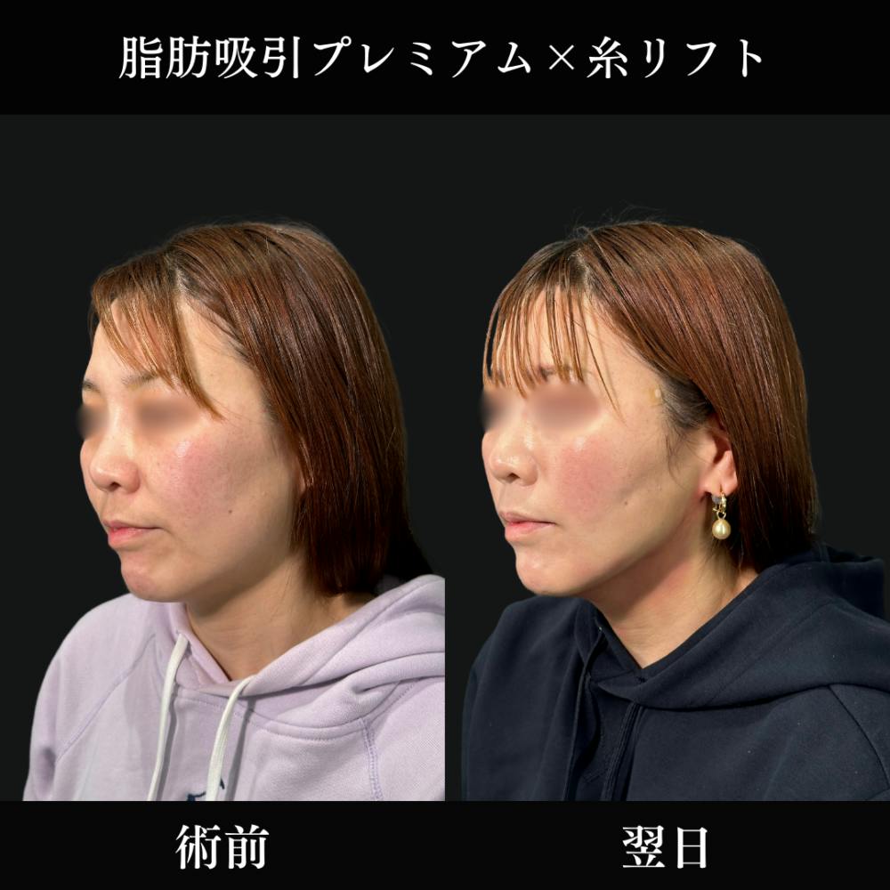 【40代女性・顔】脂肪吸引プレミアム翌日_before_aftar