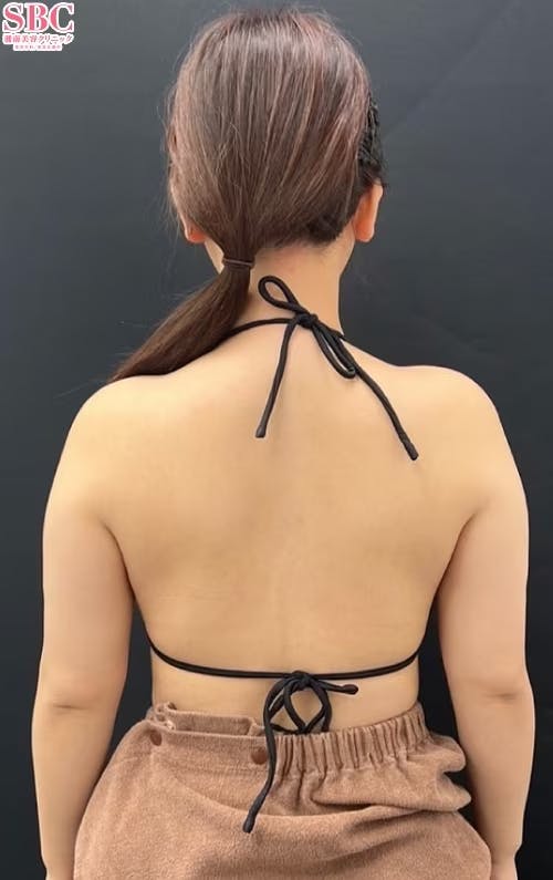 【女性・二の腕】根こそぎVASER脂肪吸引_before