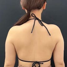 【女性・二の腕】根こそぎVASER脂肪吸引_before