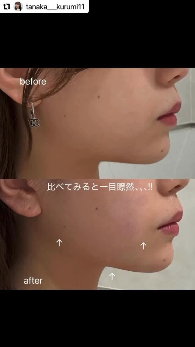 【女性・小顔】オンダプロ_before_aftar