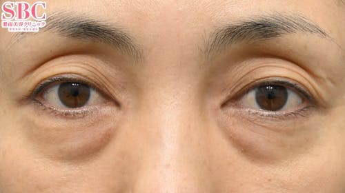 【40代女性・たるみ】アイバックリムーブ法 ナチュラル脂肪注射コンデンスリッチ ナチュラル脂肪注射ナノリッチ_before