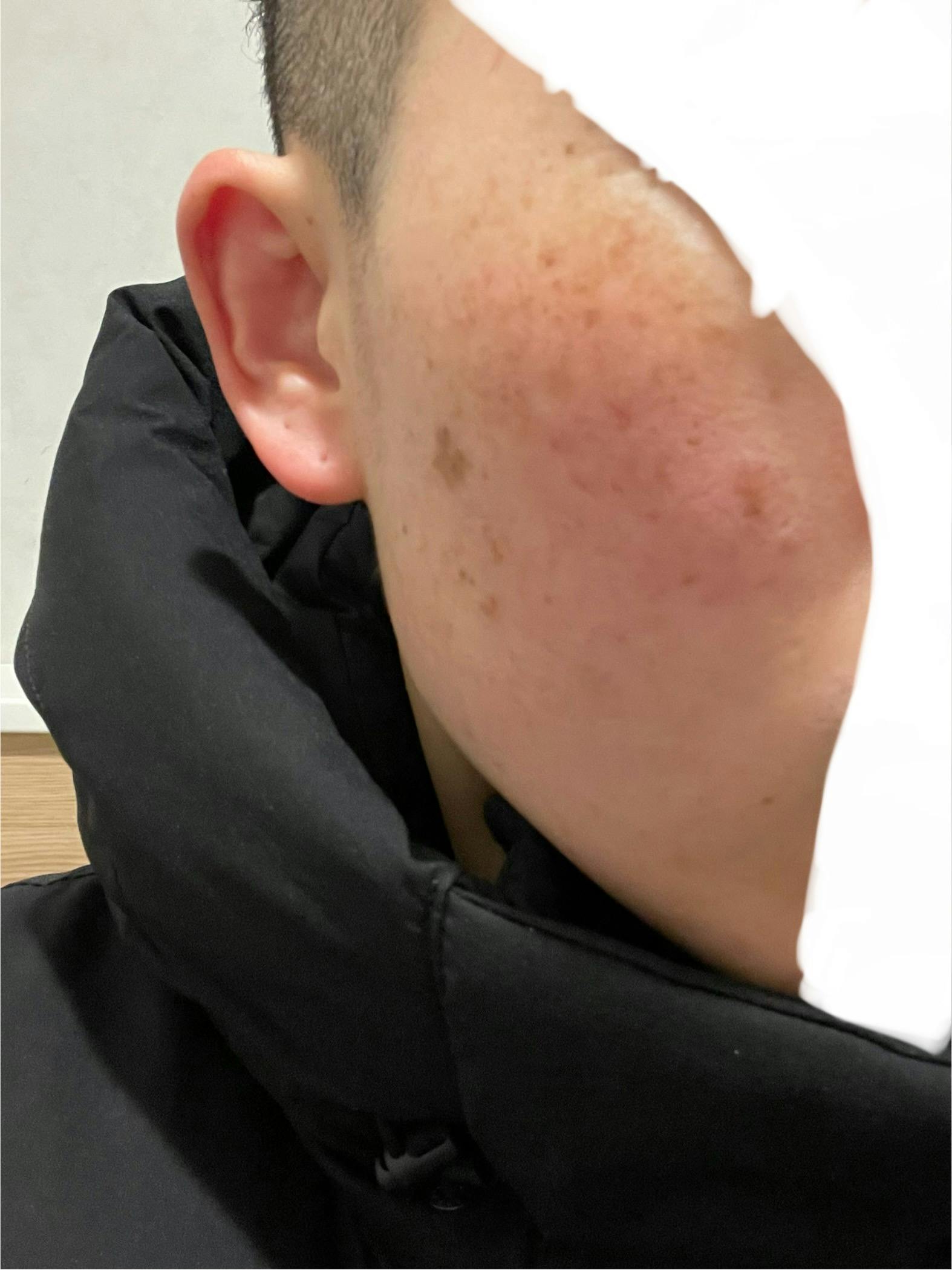 湘南美容クリニック 福岡院でシミ取りレーザーを受けたぷうさんの写真