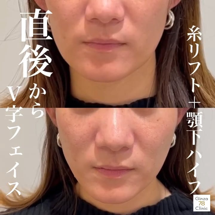【女性・たるみ】78式美肌小顔リフト 顎下ハイフ_before_aftar