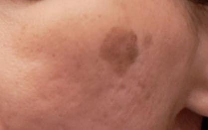 SNOW CLINICでスノーピコトーニングを受けたジャスミンさんの写真