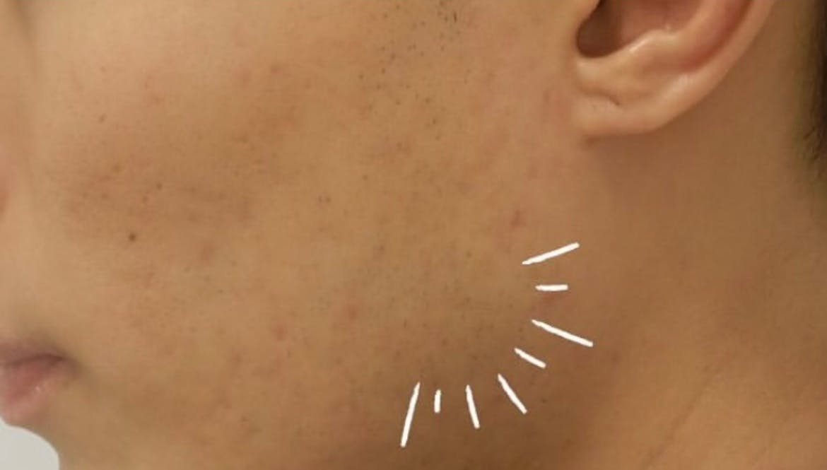 【20代男性・ニキビ】アクネトレント_a1