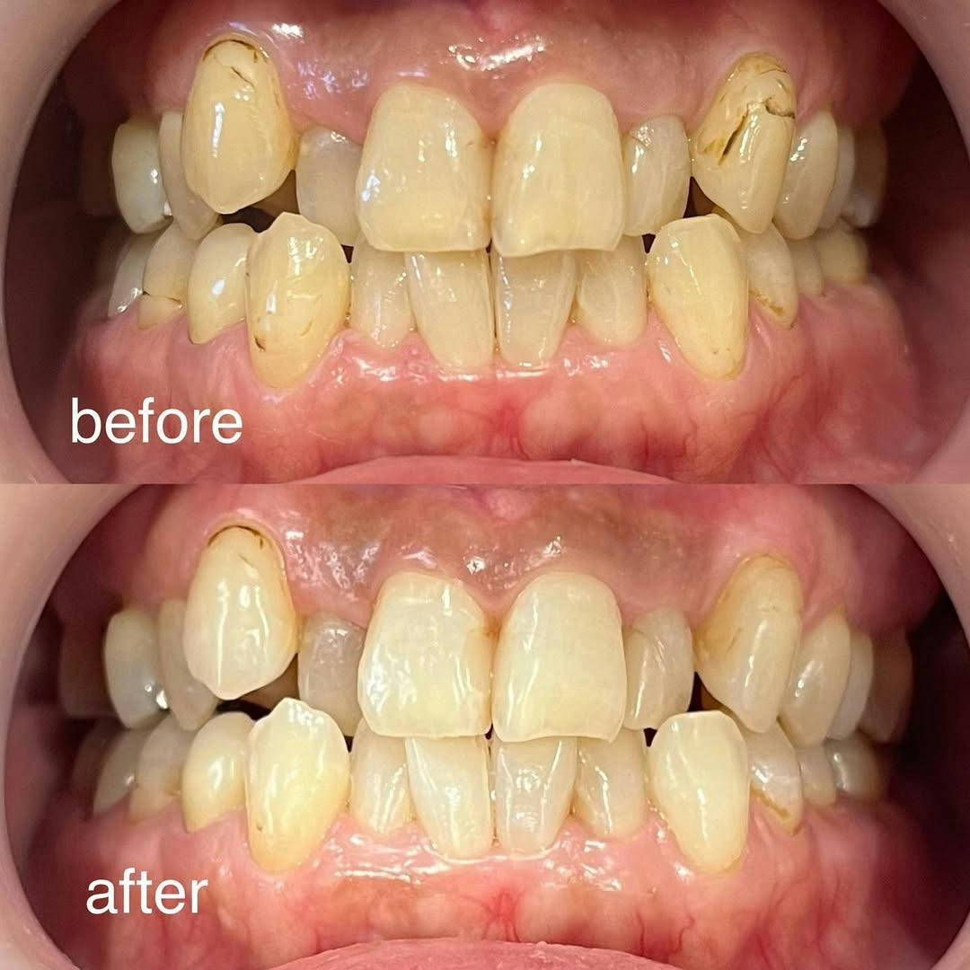 【歯】オフィスホワイトニング_before_aftar