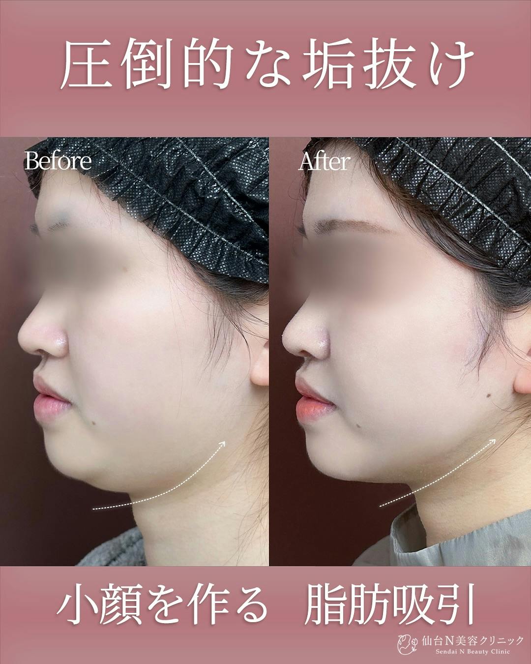 【女性・小顔】頬/顎下脂肪吸引、糸リフト、ジョールファット除去_before_aftar