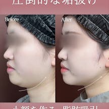 【女性・小顔】頬/顎下脂肪吸引、糸リフト、ジョールファット除去_before_aftar