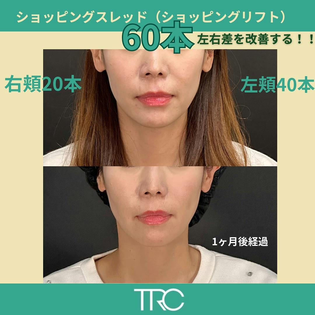 【女性・輪郭】ショッピングスレッド（ショッピングリフト）_before_aftar