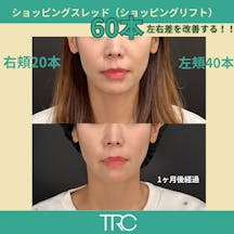 【女性・輪郭】ショッピングスレッド(ショッピングリフト)_before_aftar