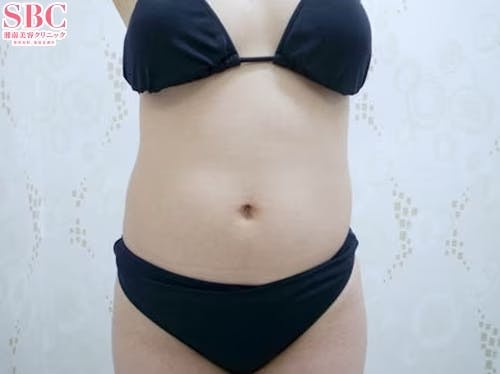 【女性・腹部】根こそぎVASER脂肪吸引、ライポマティック脂肪吸引、Aquicell（アキーセル）脂肪吸引_before