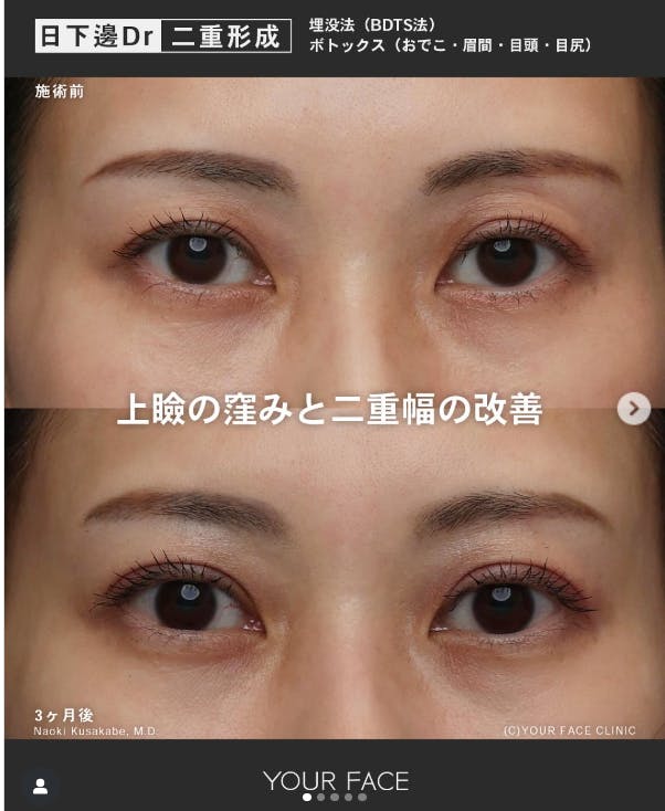 【女性・目元】埋没法_before_aftar