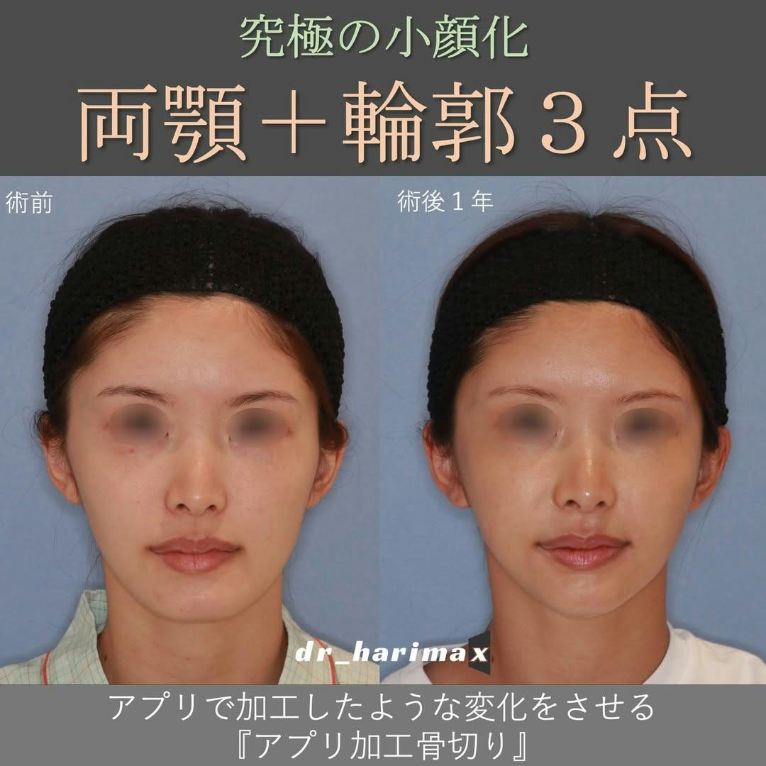 【女性・顔】上下顎骨切り術・輪郭3点_before_aftar