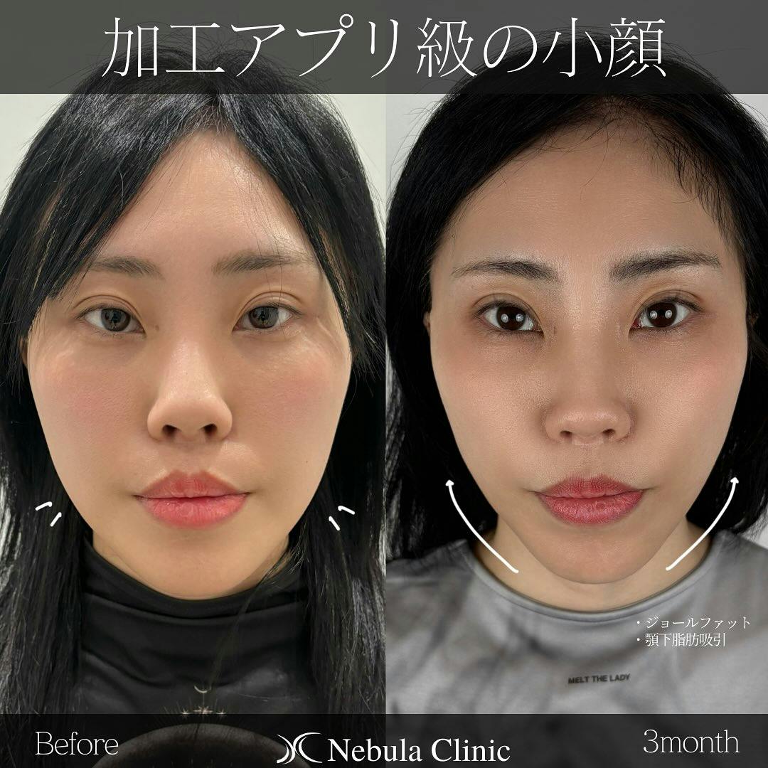 【女性・輪郭】脂肪吸引（顎下）、ジョールファット_before_aftar