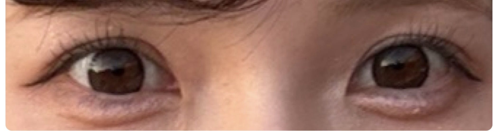 レディアス美容クリニック恵比寿でヒアルロン酸(涙袋)を受けたもぐもぐさんの写真
