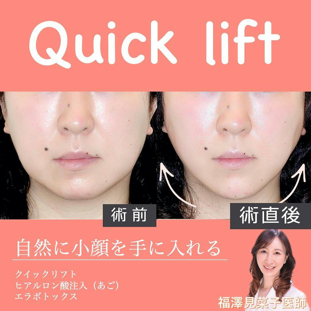 【女性・小顔】クイックリフト、ヒアルロン酸注入（あご）_before_aftar