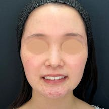 【女性・輪郭】美ボディ脂肪吸引_before