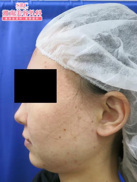 【女性・顔】根こそぎVASER脂肪吸引・ライポマティック脂肪吸引_before