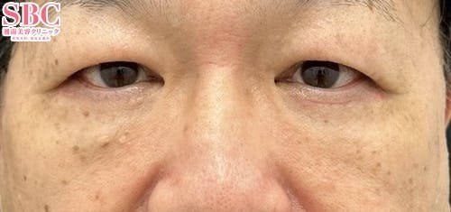 【たるみ】アイバックリムーブ法・ナチュラル脂肪注射コンデンスリッチ_after