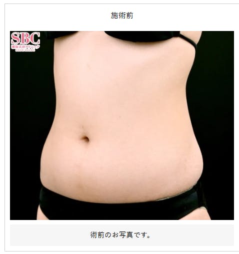 【女性・腹部】根こそぎVASER脂肪吸引_before