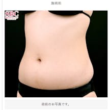 【女性・腹部】根こそぎVASER脂肪吸引_before