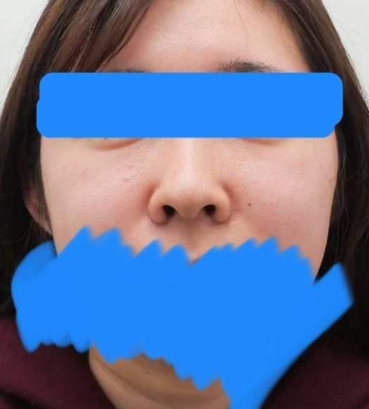 湘南美容クリニック 原宿院で隆鼻術：SBCプレミアムソフトプロテーゼを受けたみみさんの写真