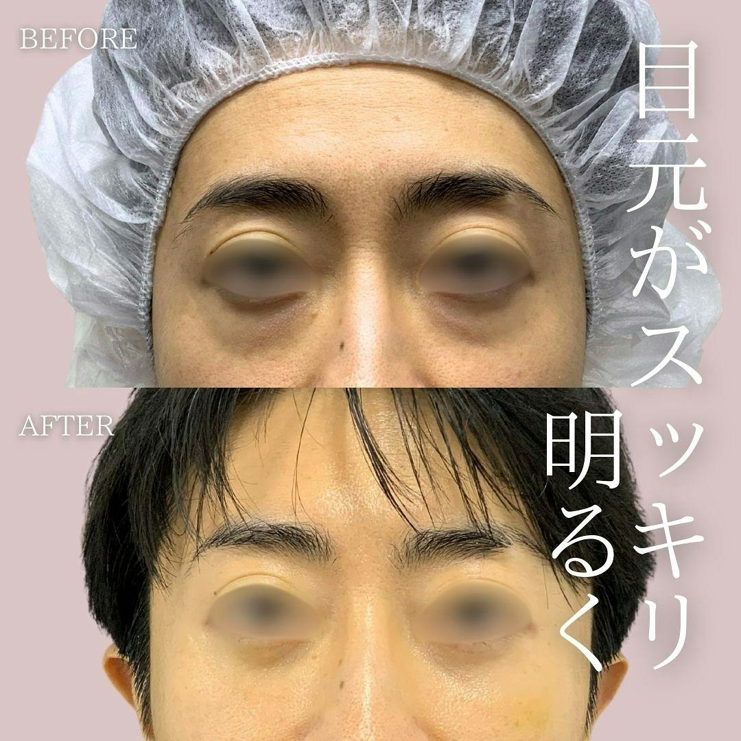 【男性・目元】クマ取り(経結膜脱脂)_before_aftar