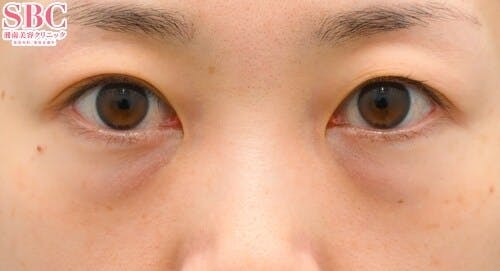 【30代女性・目元】目の下の切らないクマ・たるみ（ふくらみ）取り、ナチュラル脂肪注射コンデンスリッチ、ナチュラル脂肪注射ナノリッチ_before