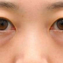 【30代女性・目元】目の下の切らないクマ・たるみ(ふくらみ)取り、ナチュラル脂肪注射コンデンスリッチ、ナチュラル脂肪注射ナノリッチ_before