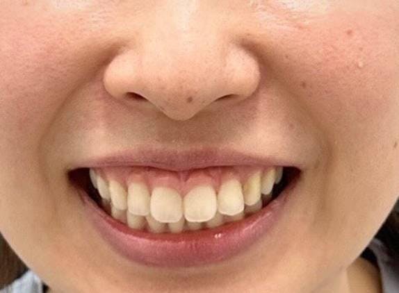 TCB東京中央美容外科 八王子院でガミースマイル治療（ボトックス・切開）：ガミースマイル治療（ボトックス注射）を受けたSABBYさんの写真
