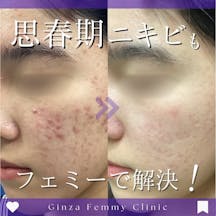 【男性・ニキビ】ケミカルピーリング・クロモライト_before_aftar