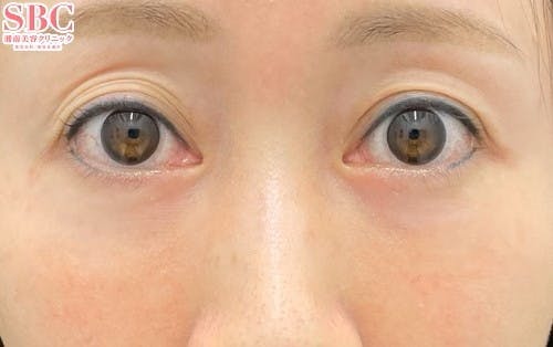 【女性・目元】裏ハムラ法 VOV（ボブ）リフト テスリフト_aftar