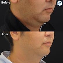 【男性・顎下】脂肪溶解注射(顎下)_before_aftar