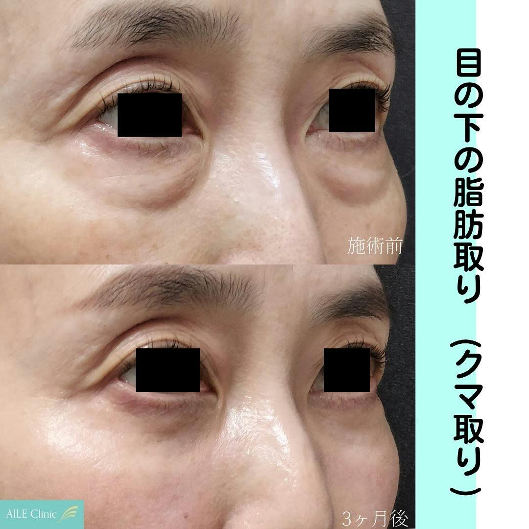 【女性・クマ】目の下の脂肪取り(クマ取り)_before_aftar
