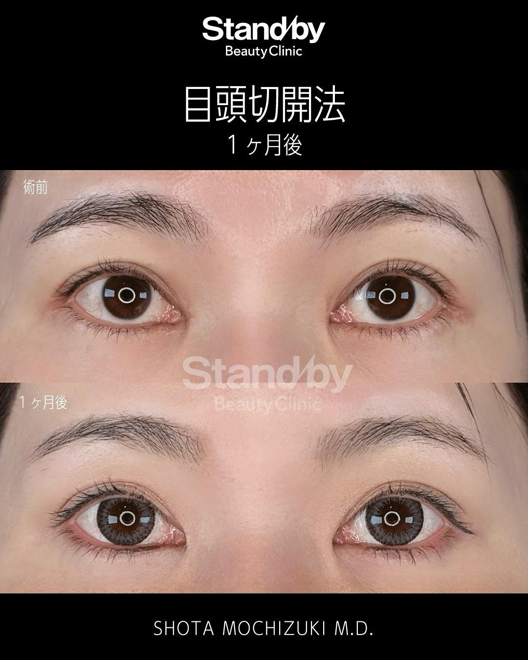 【女性・目元】目頭切開_before_aftar